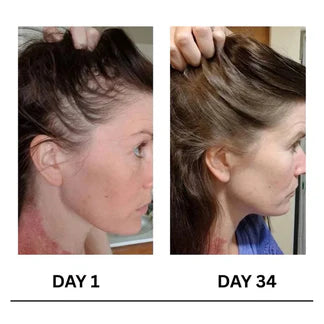 Layza™ Scalpy Boost Hair Growth Serum (Original)