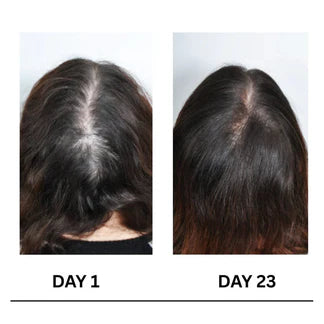 Layza™ Scalpy Boost Hair Growth Serum (Original)